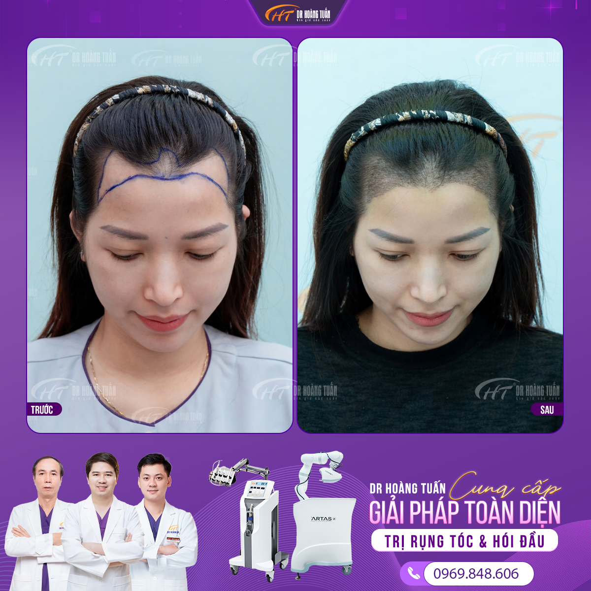 phụ nữ có bị hói đầu không